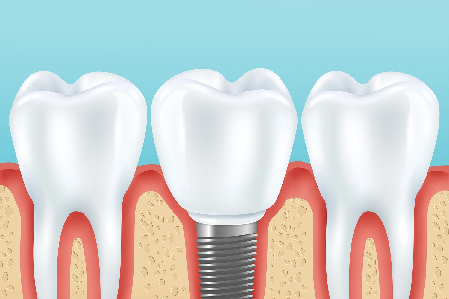 Dental Implants